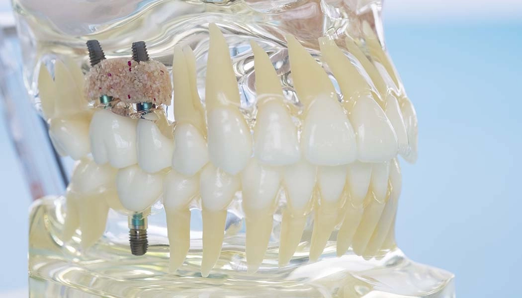 фото:Костное наращивание челюсти в районе синусов::Синус-лифтинг перед имплантацией зубов