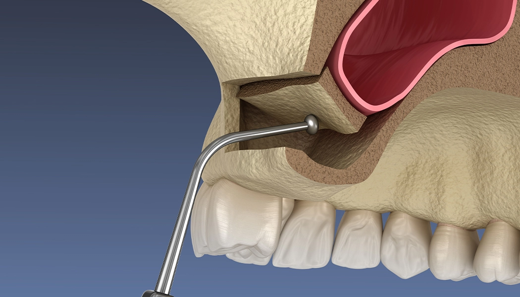 фото:Открытый синус-лифтинг для наращивания большого объёма кости::Операция по открытому синус-лифтингу