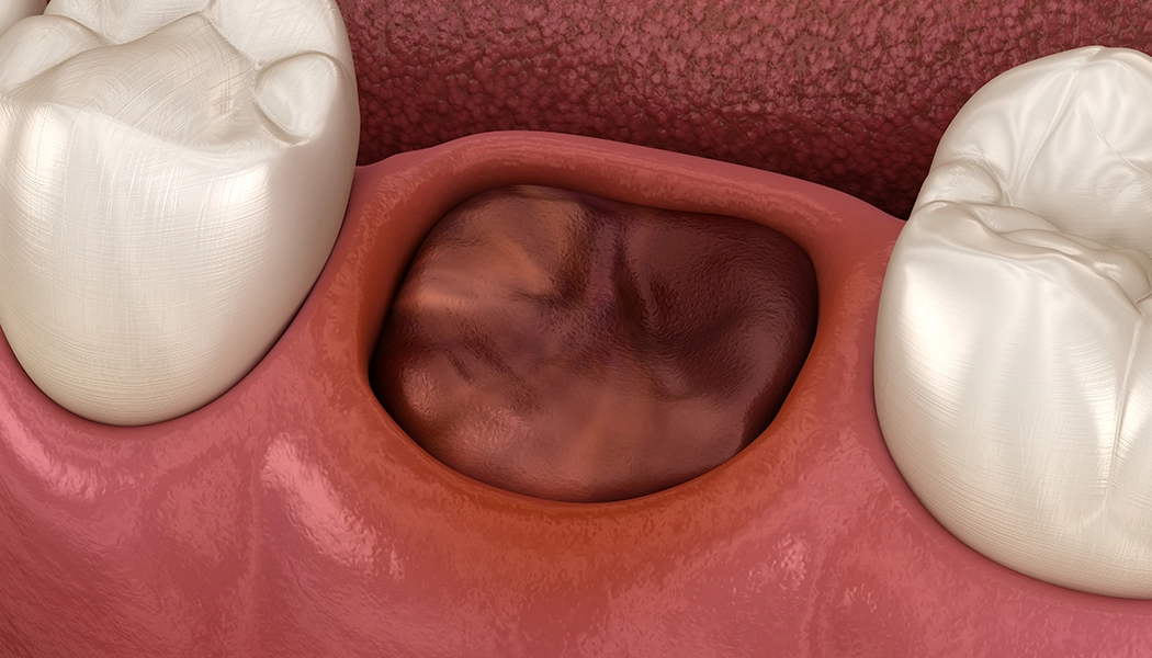 фото:Альвеолит после удаления зуба::Воспалённая лунка зуба после удаления