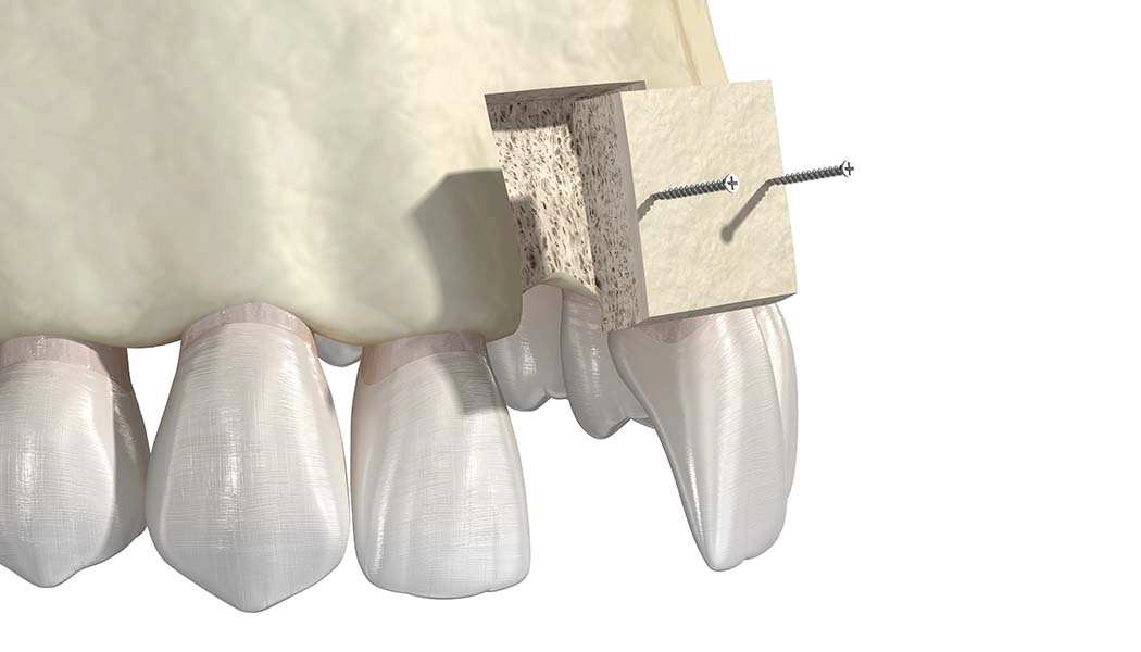фото:Подсадка костной ткани блоками при остеопластике::Остеопластика переднего отдела верхней челюсти