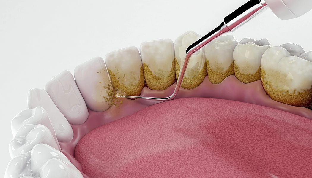 фото:Пескоструйная чистка AirFlow::Чистка зубов потоком воздуха, воды и порошка