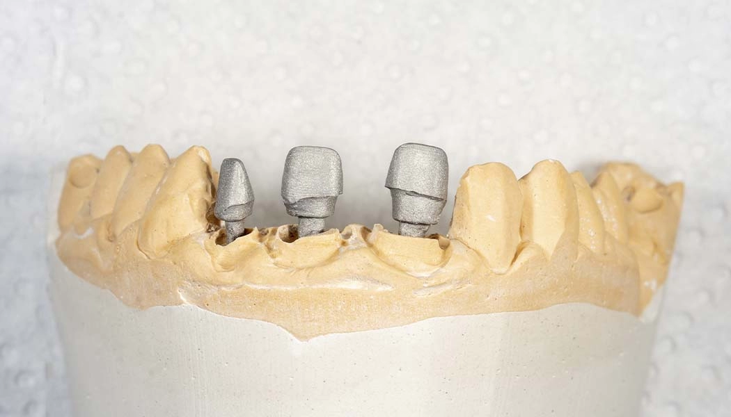 фото:Культевая вкладка для полного восстановления зуба::Восстановление коронковой части зуба культевой вкладкой